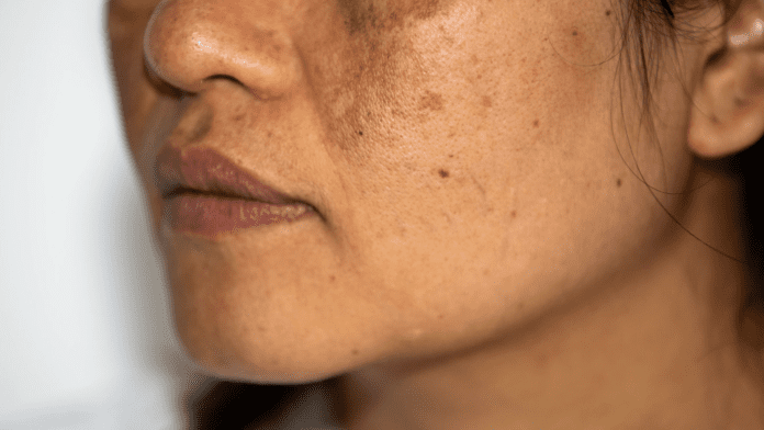 Pigmentation of Skin