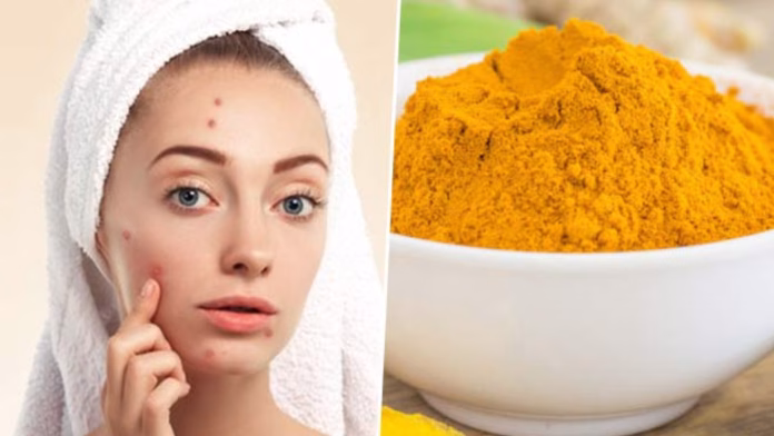 turmeric acne